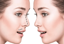 Rhinoplasty