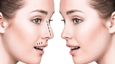 Rhinoplasty