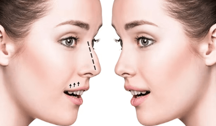 Rhinoplasty